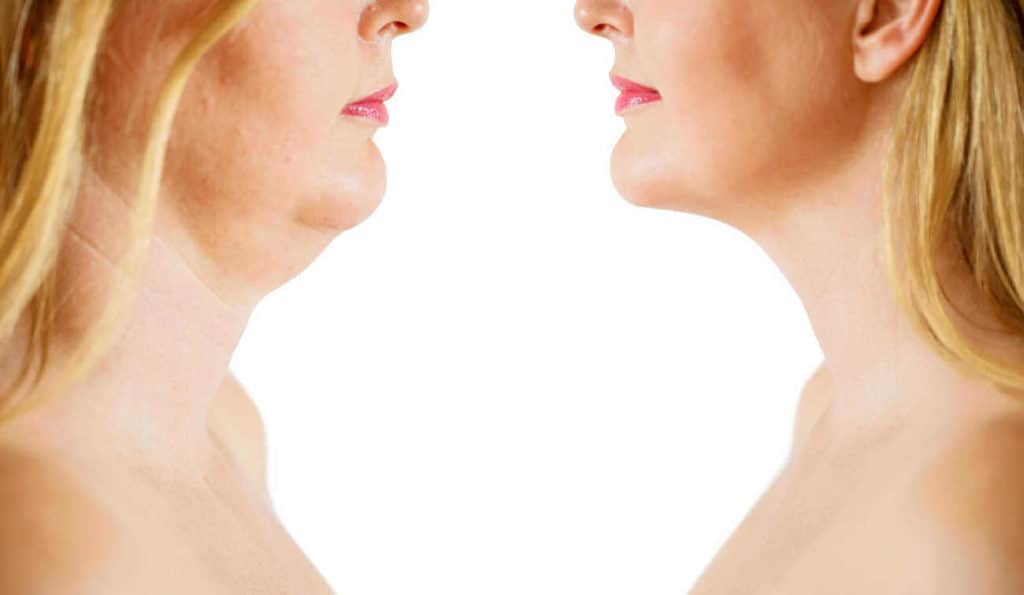Double Chin treatment Leyton before and after results