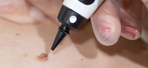 After Skin Tag Removal Leyton