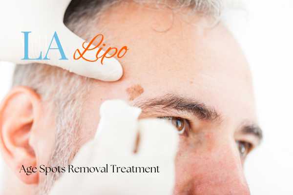 What Are the Most Effective Treatments for Age Spots Leyton?