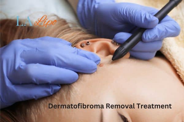 Dermatofibroma Removal Treatment Leyton