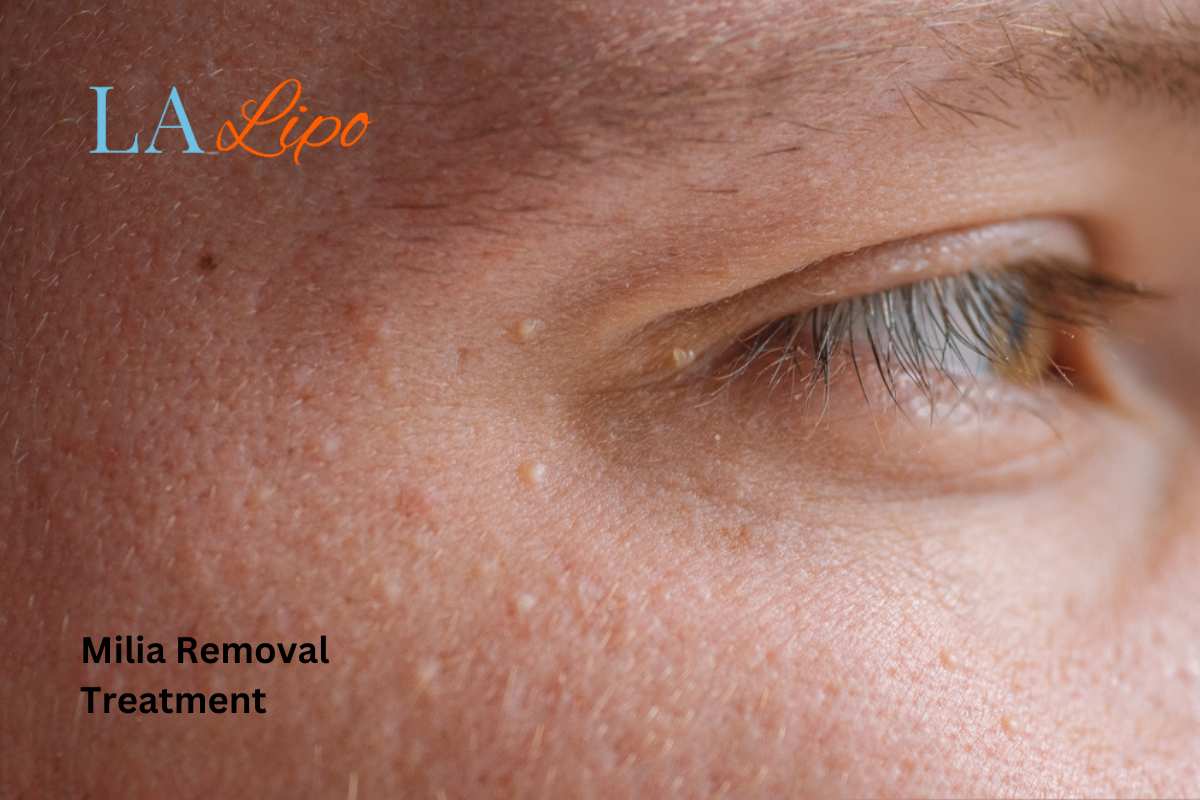 Cryopen Milia Removal: Is It the Easiest and Safest Option Leyton?