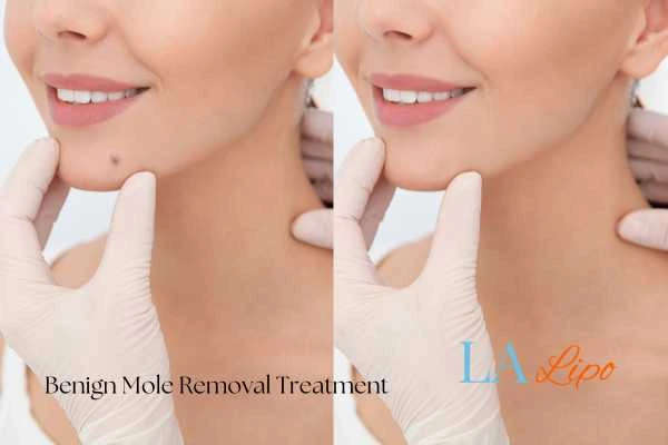 Before-and-after results following benign mole-removal treatment Leyton