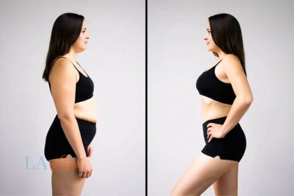 image of woman before and after results of LA-EMS Body Sculpting Leyton to help treat Diastasis recti