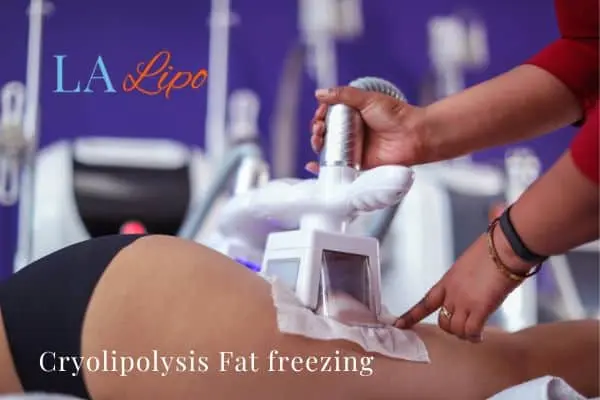 women getting fat freezing Leyton