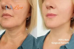 hi-fu for wrinkles Leyton before and after results