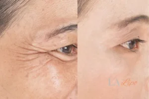 Before and after results of woman - HI-fu wrinkles reduction treatment Leyton