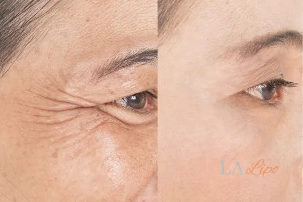 Before and after results of woman - HI-fu wrinkles reduction treatment Leyton
