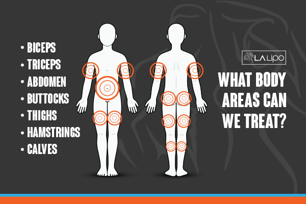 Graphic to show areas you can have LA-EMS Body Sculpting Leyton treatment.