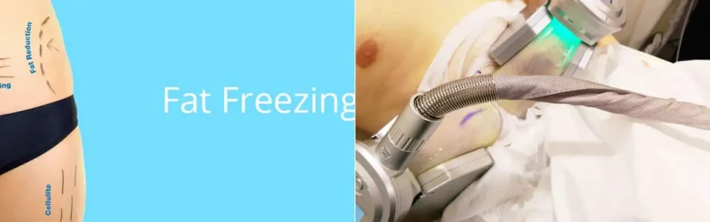 Fat freezing Leyton on multiple areas of the body