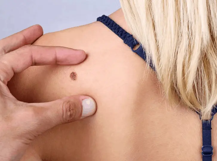 woman having mole removal Leyton consultation before treatment.