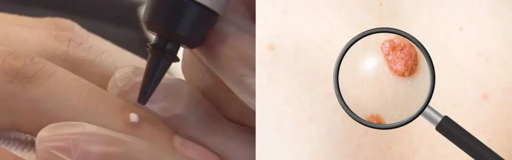 Cryopen for mole removal Leyton - speak to our team today!