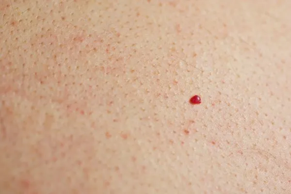 close up of a cherry angioma Leyton