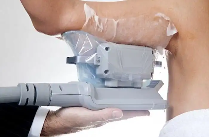 Picture of fat freezing Leyton on the upper arms.