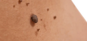 image of a skin tag Leyton