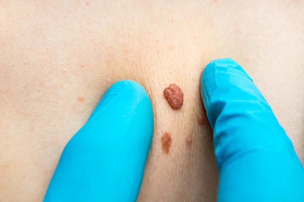 Consultant examining a skin tag Leyton