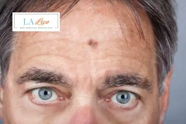 Solar Lentigo Removal Leyton image of man with mark on his forehead