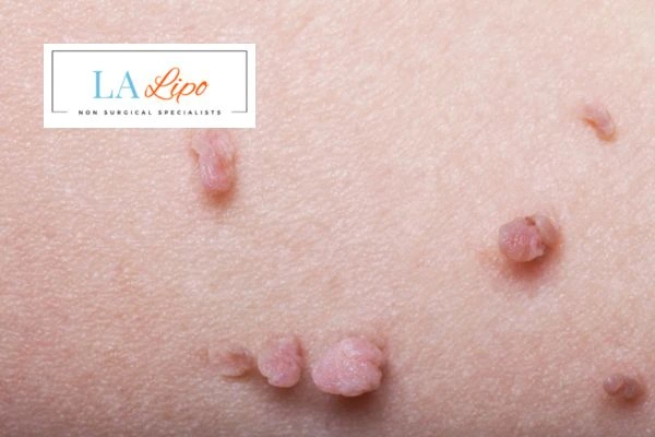 Does cryopen skin tag removal Leyton hurt? Find out now call our team today!