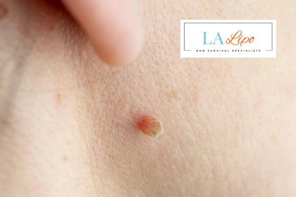 Book skin tag removal Leyton today speak to our team now!