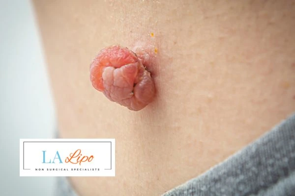 Interested in skin tag removal Leyton? Concerned about the pain? Find out more today!