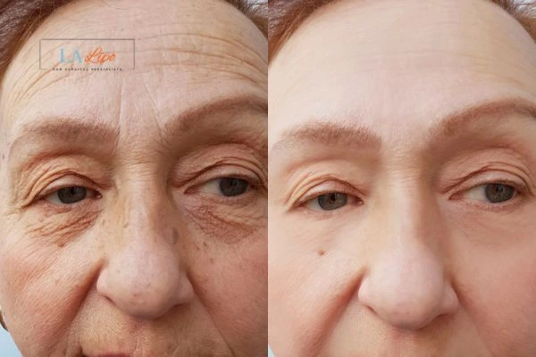The powerful benefits of Morpheus8 Treatment Leyton - Call Our team today!