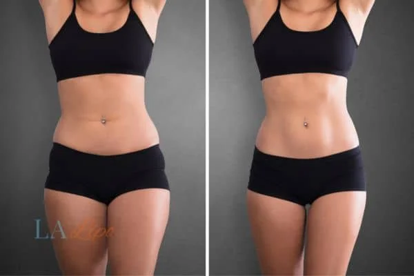 before and after results of non-surgical treatment to help a woman's body image and mental health Leyton