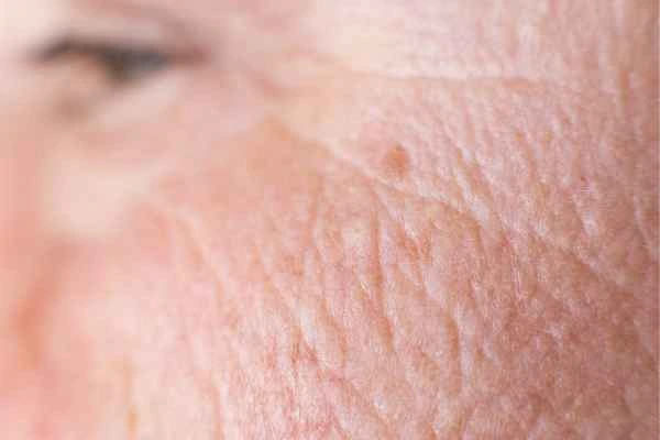 close up picture of a woman's face showing an age spot Leyton
