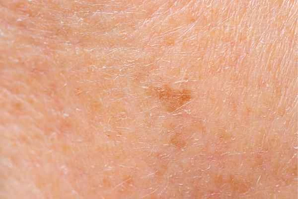 close up picture of age spots Leyton