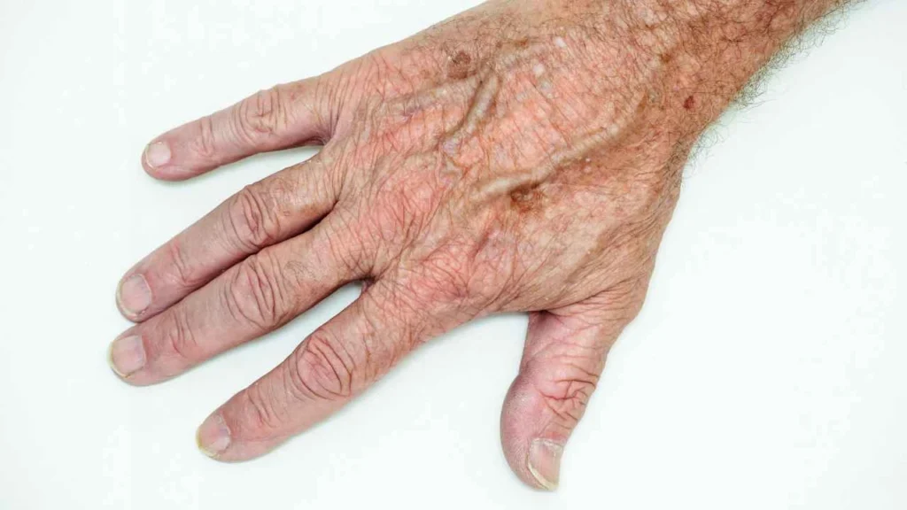 Male hand showing age spot Leyton