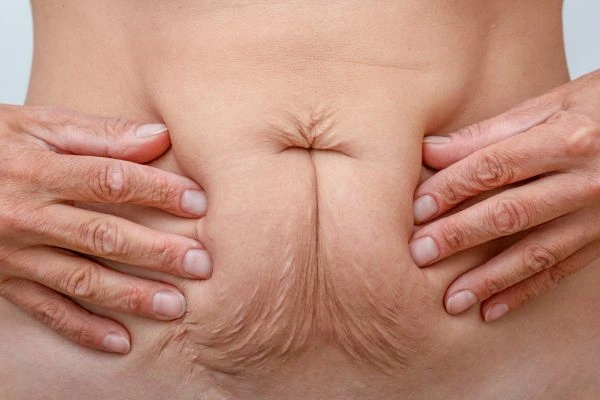 Image of a woman's stomach with loose skin - example of skin tightening Leyton options