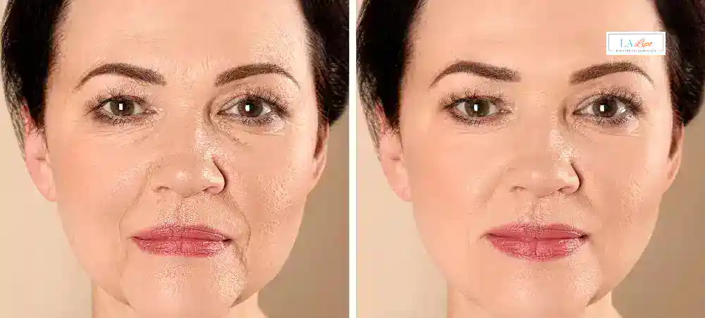 How Long Does It Take to See Results and How Long Do They Last Leyton?