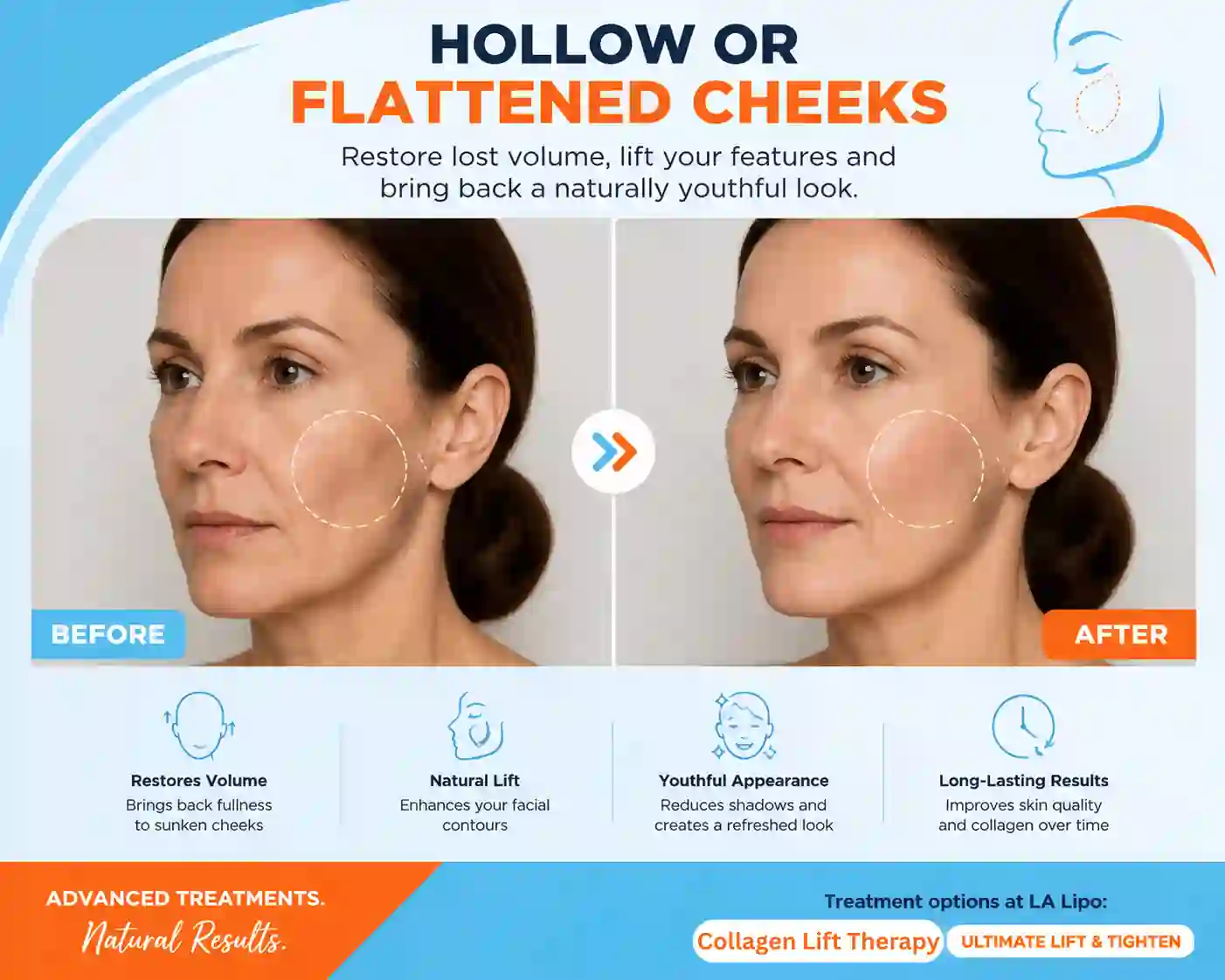 Sign #4: Hollow or Flattened Cheeks Leyton